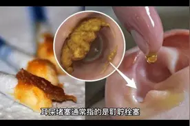 如何知道自己是否有耳屎堵塞视频封面