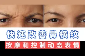 超过50岁出现鼻横纹别担心，两个方法教你改善