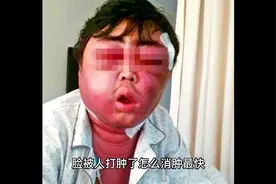 脸被人打肿了怎么消肿最快视频封面