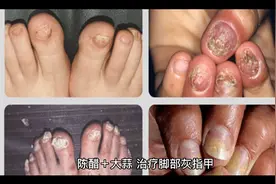 陈醋+大蒜，治疗脚部东指甲