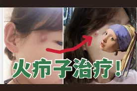 火疖子治疗后继来了，三天恢复很多，遇到火疖子一定要及时治疗！