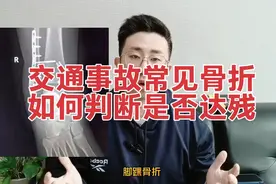 交通事故常见骨折如何判断是否达残。#伤残鉴定 #伤残 #交通事故视频封面