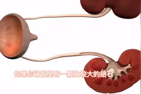 肾脏里有一颗大结石，通过腰上打洞手术清理干净，真酸爽！视频封面