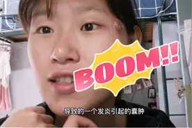 全网最详细火疖子症状及治疗过程！长火疖子不要慌及时治疗是王道