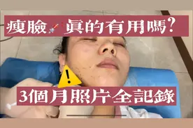 传说中的瘦脸针真的有用吗？？3个月照片记录脸形的变化！视频封面