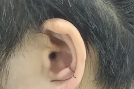 付老师教你学耳穴:对耳屏8穴