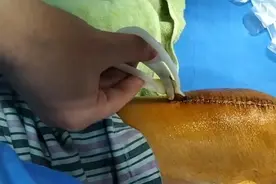 伤口拆线全过程，今天拆一半，明天拆完，后天出院，身体全好了。
