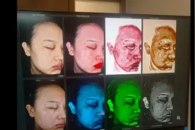 激光祛斑过程的第六天 掉痂后护理