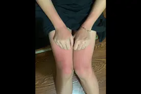 皮肤晒伤脱皮起泡变黑全过程，出去玩一定做好防晒呀