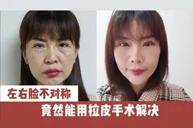 真实案例讲解，左右脸不对称，拉皮手术能解决到什么程度？