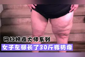 女子左腿长了30斤的脂肪瘤，网红医生抽出3000毫升油脂，太解压了视频封面