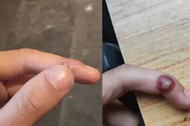 手指长了瘊子（寻常疣you），做了冷冻一个月了视频封面