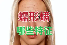 脸上有蠕形螨的人会有哪些特征？重点要看脸部的这4个部位特征！