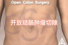 开放结肠肿瘤切除动画演示，为外科医生点赞！