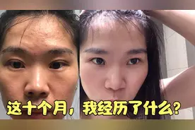 我是如何从满脸油腻痘痘肌变成皮肤干净透亮的？秘籍在这：刷va酸视频封面