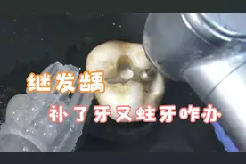 科普蛀牙补牙知识：补过的牙齿又蛀牙了怎么办？