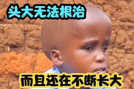 纪录片：15岁女孩，顶着一个逐渐增大的脑袋，走到哪都被人注视视频封面