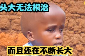 纪录片：15岁女孩，顶着一个逐渐增大的脑袋，走到哪都被人注视视频封面