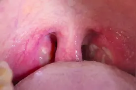 喉咙痛可以由哪些疾病引起？视频封面