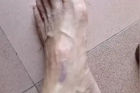 脚被砸的一团淤血，擦点祖传药酒活血化瘀。见效真快