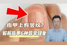 为什么指甲上有竖纹？帮你了解关于指甲的6种常见现象！视频封面