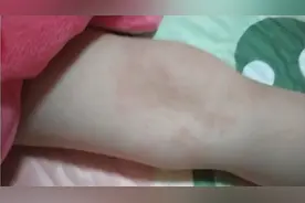小雪腿上长满了泡好像得了紫癜，过程很吓人结局很意外，