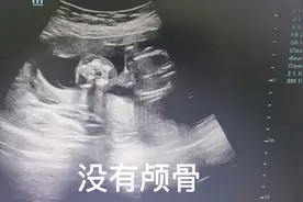 今天遇见无脑儿一例！这种致死性畸形需要早发现、早诊断、早处理视频封面