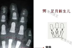 男性骨龄标准图谱