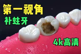 第一视角看医生补蛀牙，牙齿已经被掏空，但最后竟然能完美修复！视频封面
