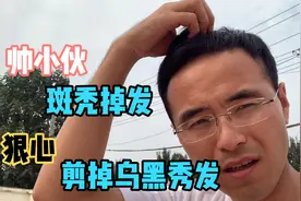 小伙发现自己斑秃，为了治疗狠心剪掉乌黑秀发，记录生长发过程