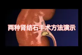 两种肾结石手术方法演示，你觉得哪种好？