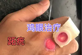 治疗鸡眼跖疣办法