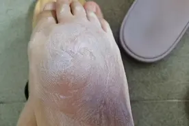 野外拍视频被蚂蚁咬肿，奇痒无比，没买药涂了几次这个，慢慢好了