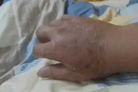 断了一根手指头，中草药包了21天，恢复差不多了