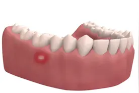 口腔溃疡产生原因，怎么治疗预防，3D演示。。视频封面