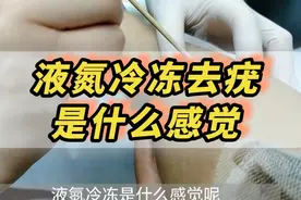 时隔两个月，第二次液氮冷冻治疗疣、瘊子#液氮冷冻 #液氮视频封面
