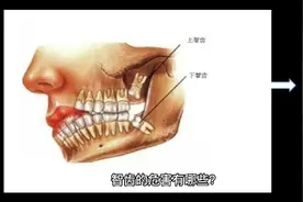 智齿的危害有哪些？智齿的危害有多大？本期视频告诉您。