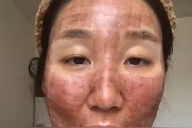 武汉点阵激光治疗痘坑恢复第二天视频封面