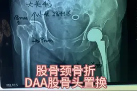 87岁患者股骨颈骨折微创智能DAA股骨头置换视频封面