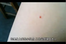 身上有一点一点的血痣是怎么回事