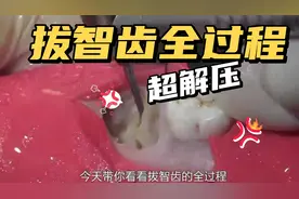 解压视频！拔智齿全过程，只是看看就感受到了酸爽~超解压