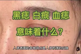 身上长黑痣  白癍   血痣，到底意味着什么？