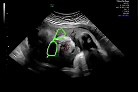 34周胎儿孕期超声数据视频讲解…