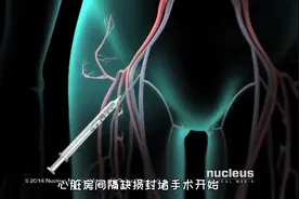 这么神奇，微创介入心脏房间隔缺损封堵手术过程，3D演示。。