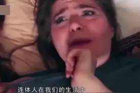 一个特殊群体的【连体人】视频封面