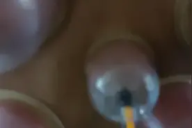 上次长了火疖子，开口拔罐已痊愈，感恩信任，认真尽心继续