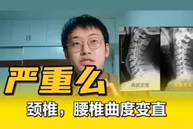 颈椎，腰椎曲度变直，啥意思，严重么？需要如何改善纠正？视频封面