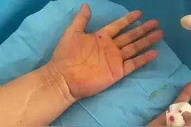 腱鞘炎  小针刀治疗  立竿见影视频封面