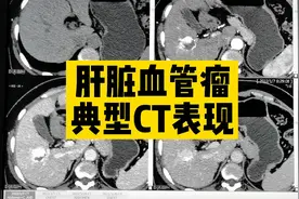 【基础知识】临床医生了解，肝脏血管瘤快进慢出典型CT表现视频封面