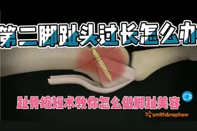 第二趾骨过长，利用模块摆据缩短趾骨美容的手术方法